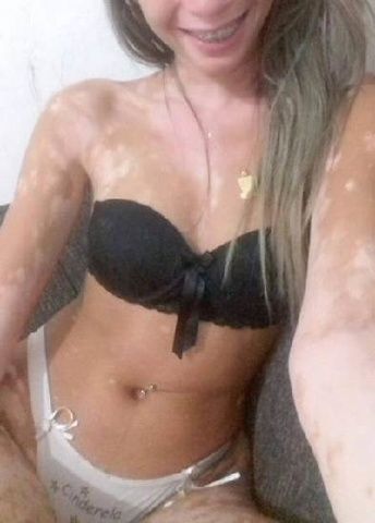 Caiu na net loira gostosa com vitiligo exibindo bucetinha - GO